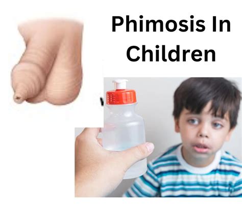 fimosis foto|Phimosis – Pictures, Definition, Causes, Treatment。